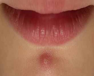 از بین بردن جوش زیر پوستی برای همیشه